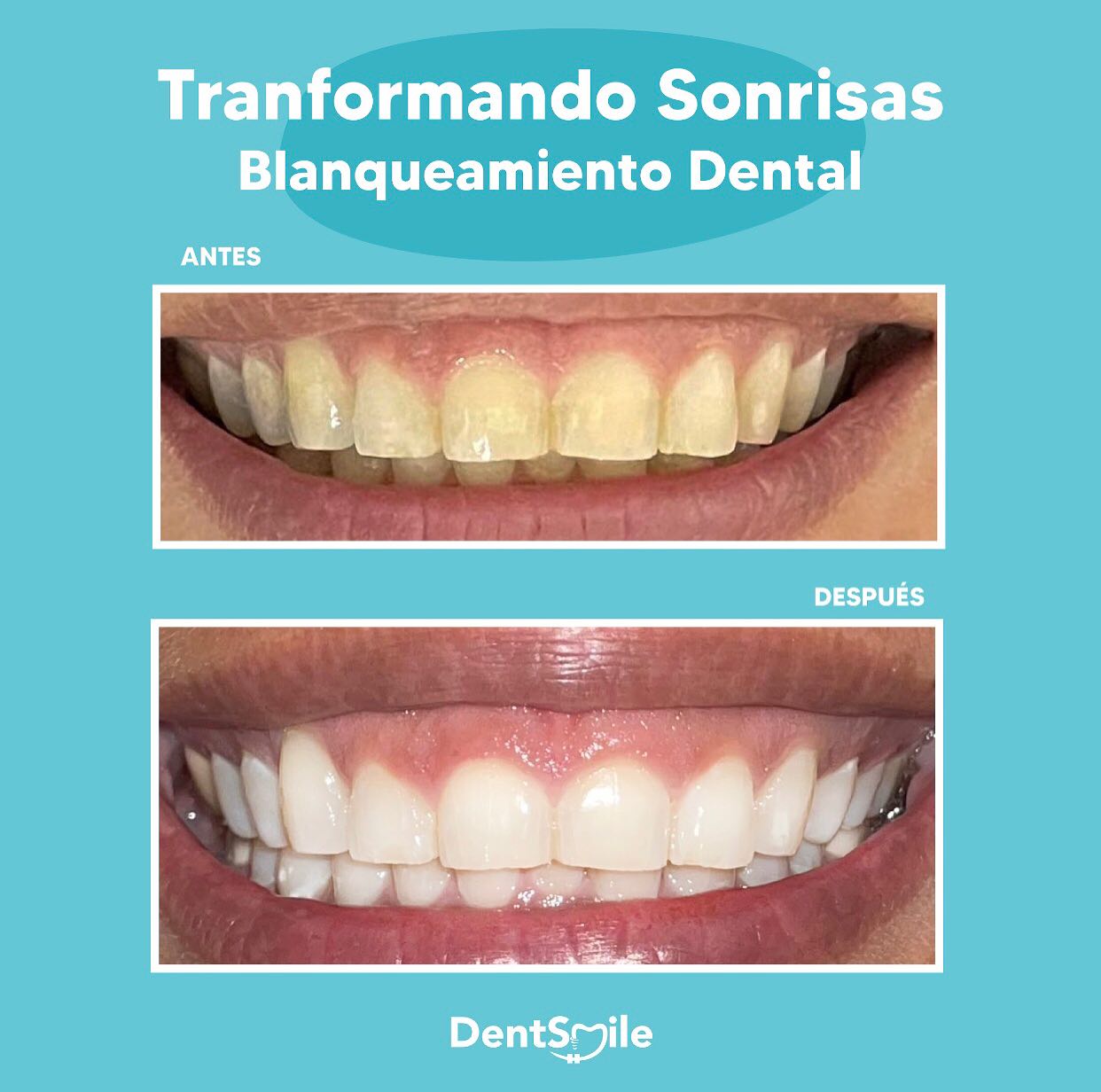 Blanqueamiento Dental en Mérida