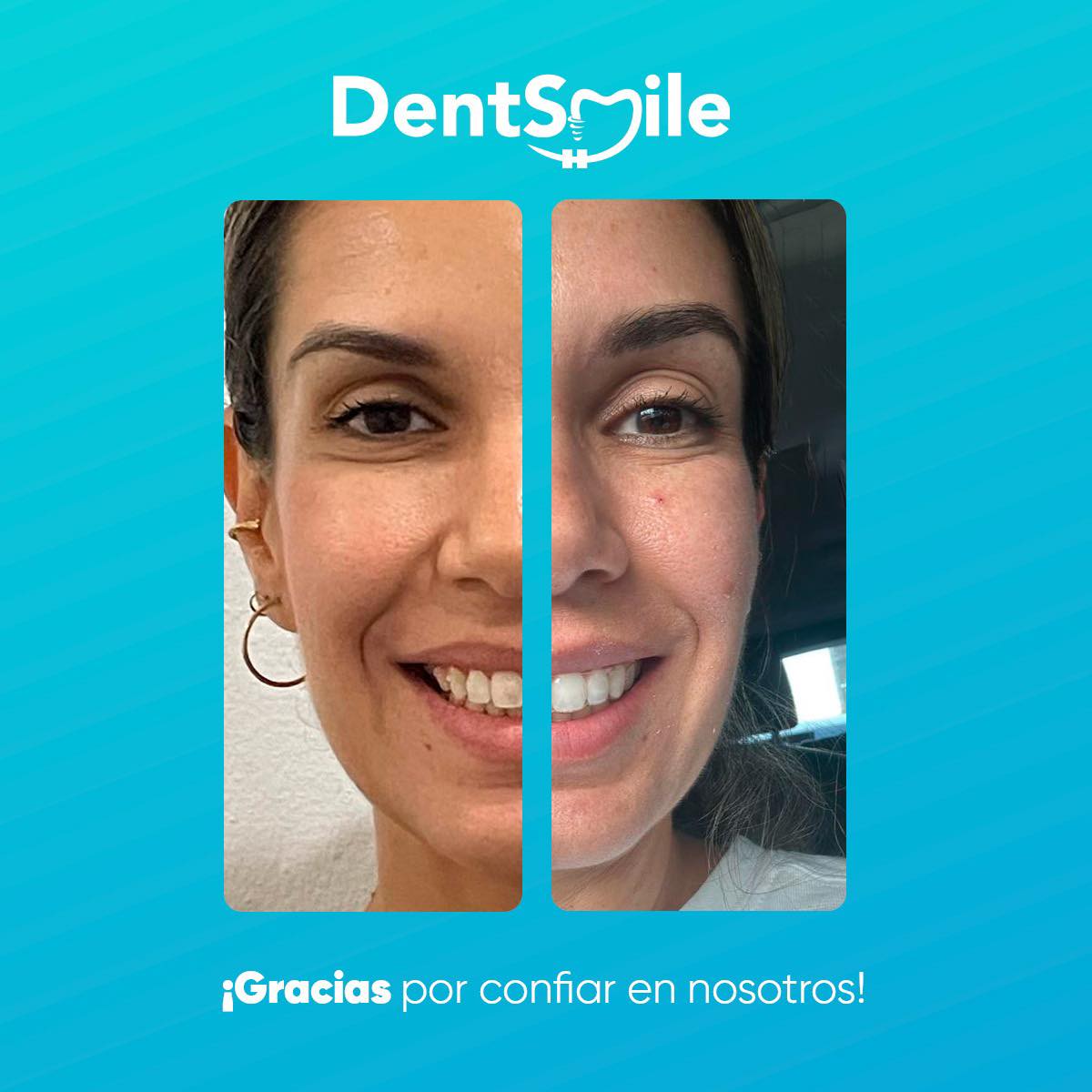 Limpieza profunda de dientes en Mérida